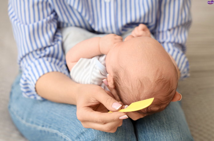 Cradle cap in babies