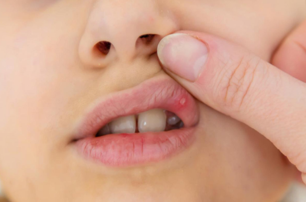 Mouth Ulcers in Children