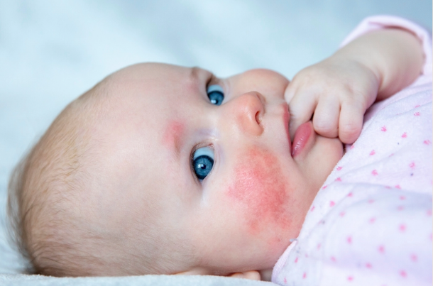 Is It Normal for Newborns to Have Rashes