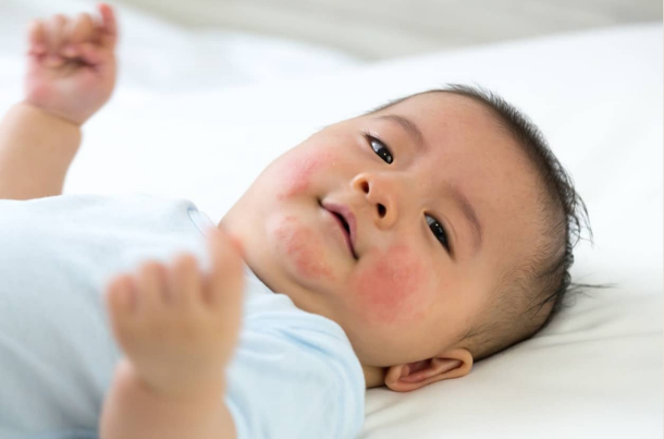 Is It Normal for Newborns to Have Rashes