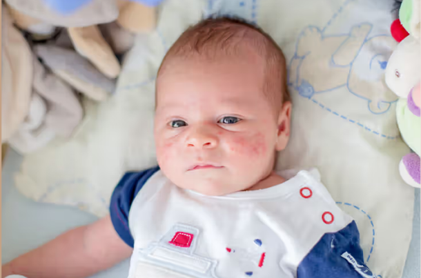 Is It Normal for Newborns to Have Rashes